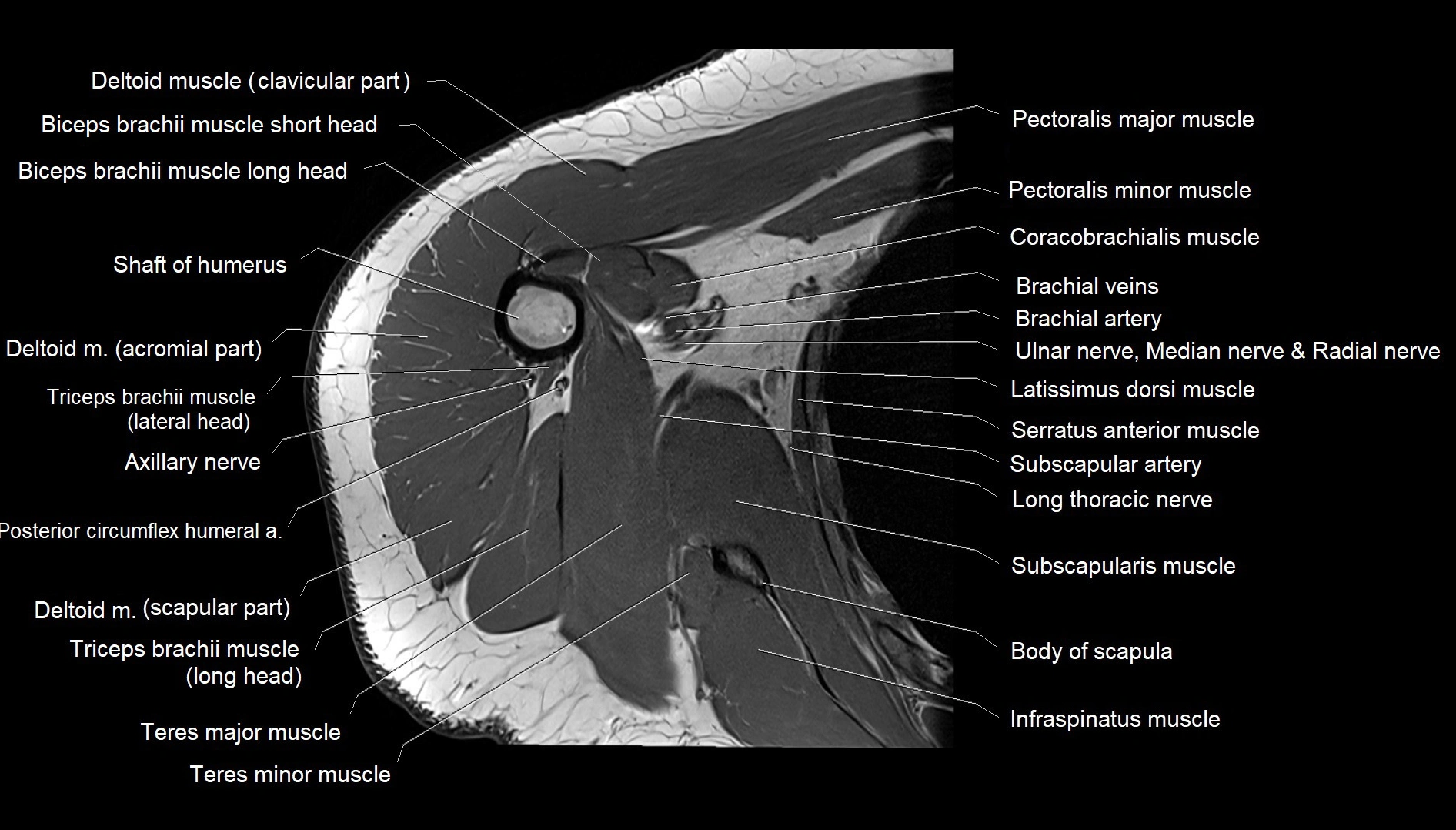 Shoulder cross sectional anatomy MRI 3T axial image 36.webp